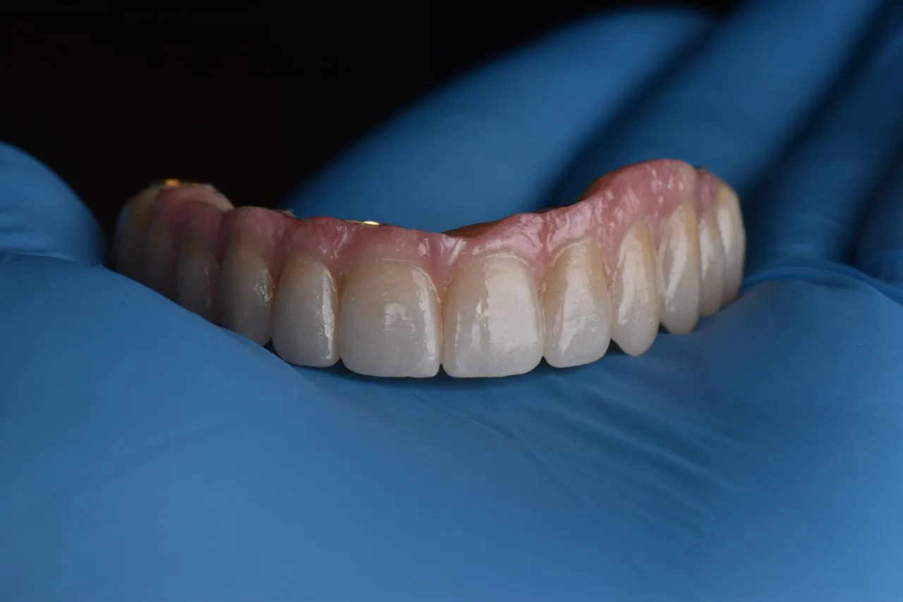 Foto de prótesis sobre guante